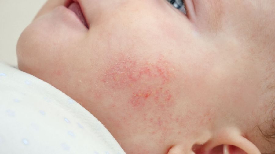 Blog TACKLING BABY ECZEMA